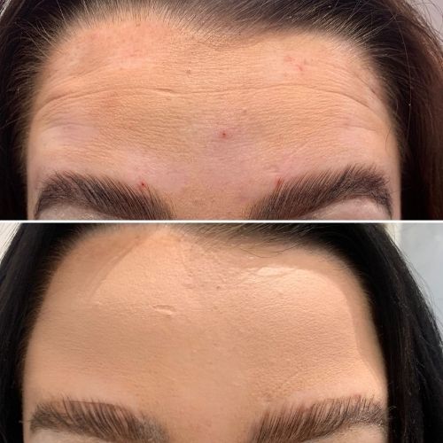 ANTI WRINKLE TREATMENTS AT MAKEOVER PALACE HAIR & BEAUTY SALON IN KIDLINGTON, OXFORD