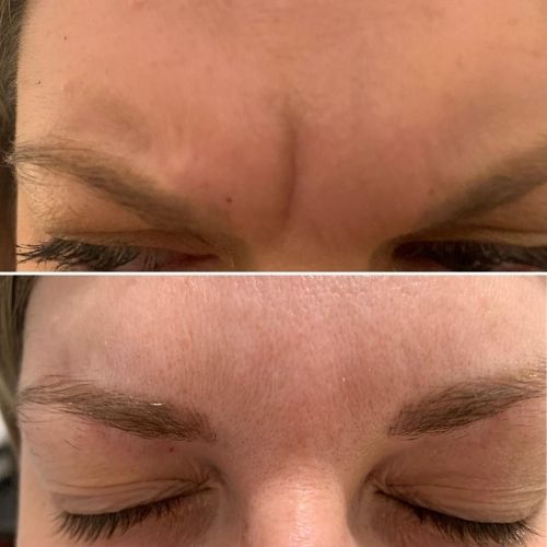 Makeover Palace Anti Wrinkle Treatments 2 ANTI WRINKLE TREATMENTS AT MAKEOVER PALACE HAIR & BEAUTY SALON IN KIDLINGTON, OXFORD