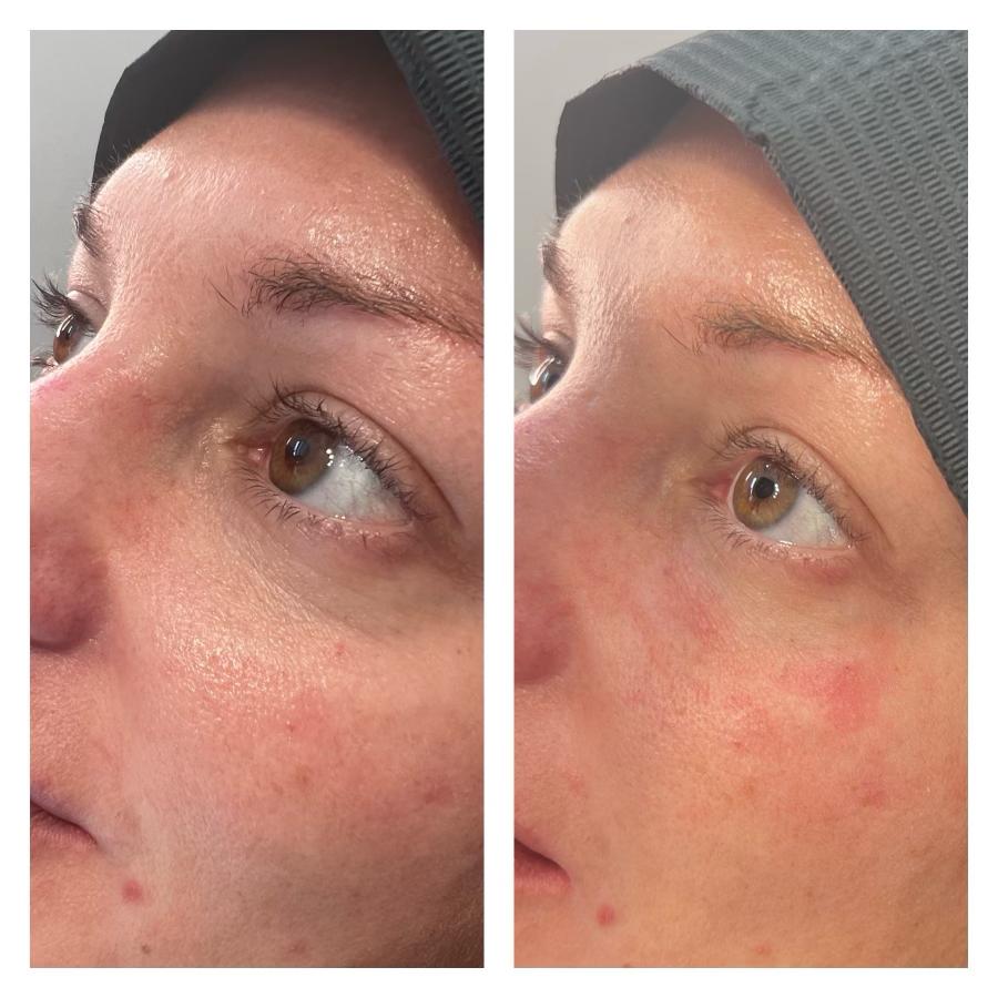 2 11 ANTI WRINKLE TREATMENTS AT MAKEOVER PALACE HAIR & BEAUTY SALON IN KIDLINGTON, OXFORD
