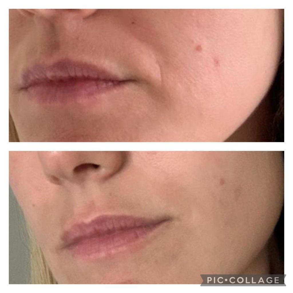 Makeover Palace Anti Wrinkle Treatments 1