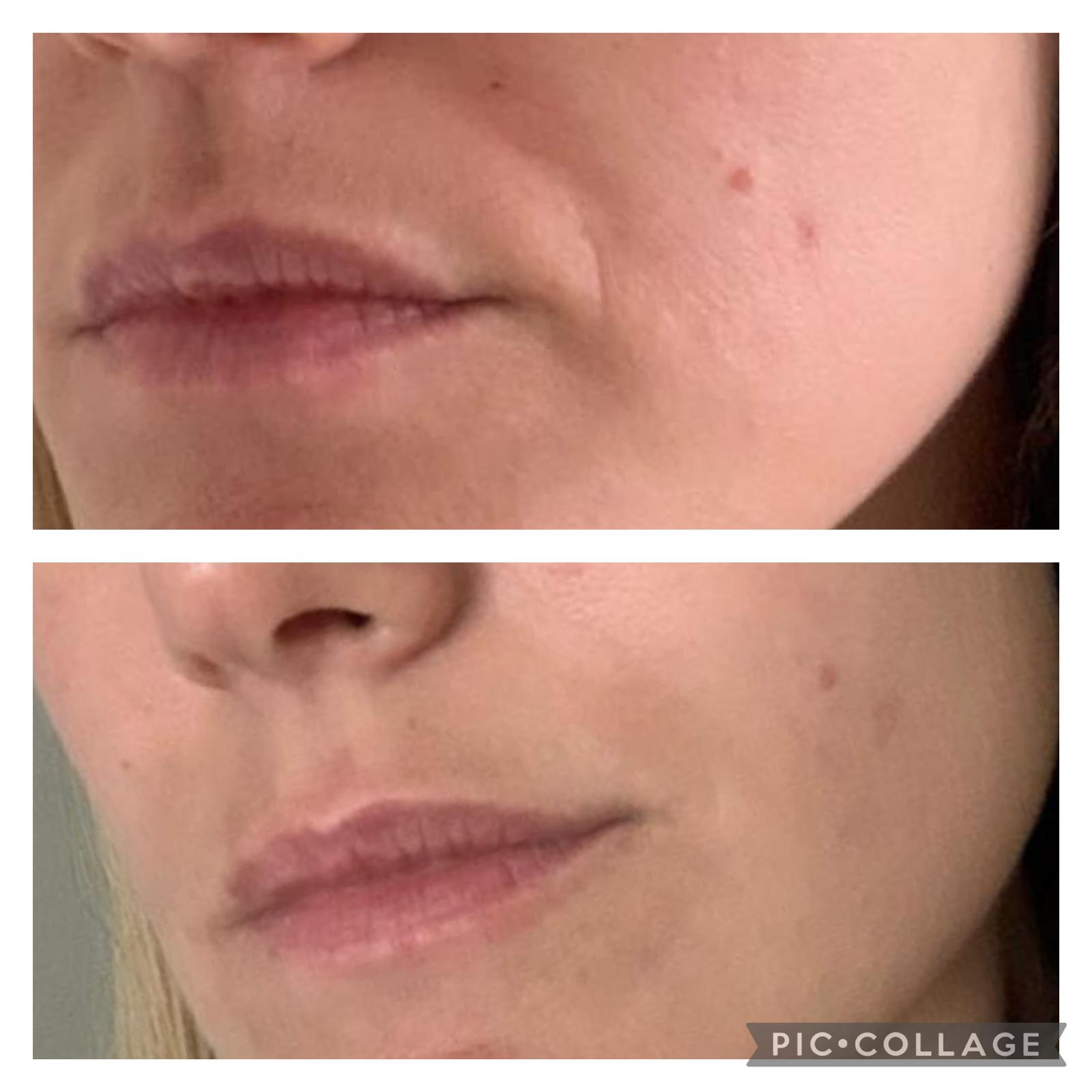 4 3 ANTI WRINKLE TREATMENTS AT MAKEOVER PALACE HAIR & BEAUTY SALON IN KIDLINGTON, OXFORD