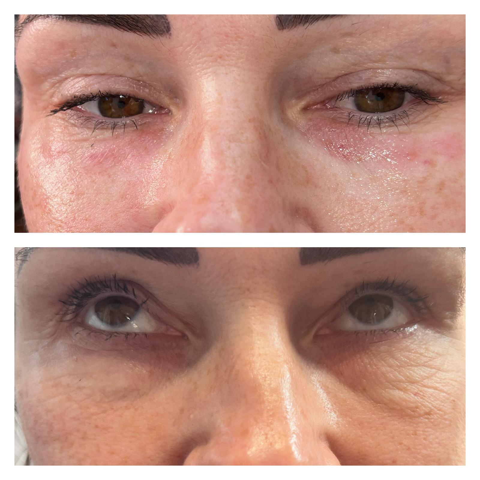 5 2 ANTI WRINKLE TREATMENTS AT MAKEOVER PALACE HAIR & BEAUTY SALON IN KIDLINGTON, OXFORD