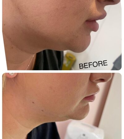 Fat Dissolving Injections in Kidlington