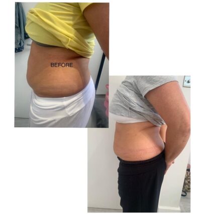 Fat Dissolving Treatments in Oxford