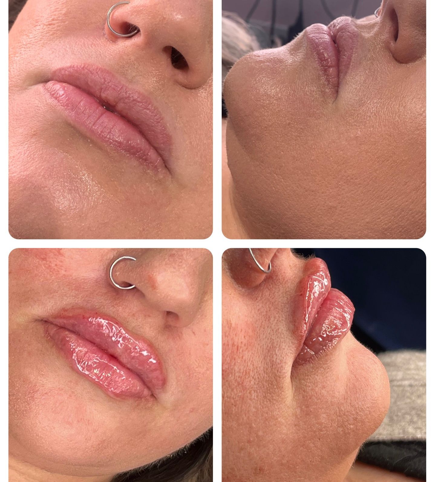 Russian Lips 2 Russian Lip Fillers in Oxford