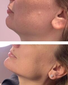Dermal Fillers in Kidlington
