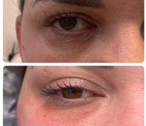 Skin Booster Injections Kidlington
