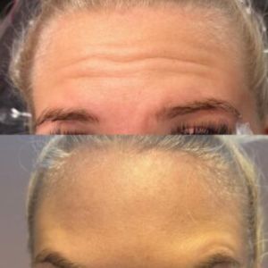 Anti aging treatment