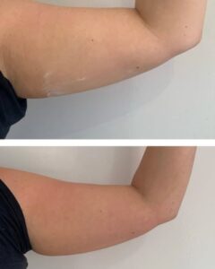 Lemon Fat loss Injection results