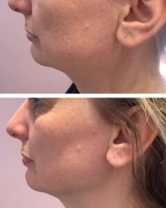 Lemon Bottle Fat Loss Injection results at Makeover Palace