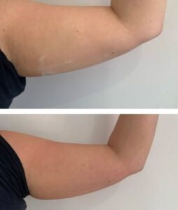 fat dissolving treatments Kidlington